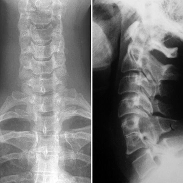 X -Ray der Halswirbelsäule