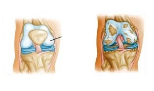 pathologische Veränderungen bei der Kniearthrose