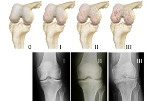 Methoden zur Diagnose von Arthrose des Knies