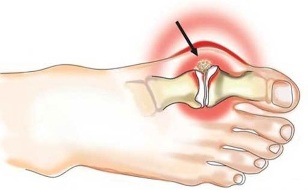 Entzündung des Gelenks zwischen Daumen und Fuß bei Arthritis